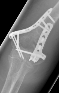 Verschobener körperferner Oberarmbruch, Versorgung mit zwei winkelstabilen, anatomischen Platten von vorne