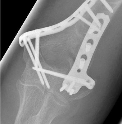 Verschobener körperferner Oberarmbruch, Versorgung mit zwei winkelstabilen, anatomischen Platten von vorne