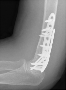 Verschobener körperferner Oberarmbruch, Versorgung mit zwei winkelstabilen, anatomischen Platten von der Seite