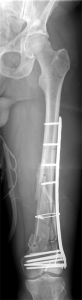 Trümmerbruch des körperfernen Oberschenkels - Versorgung mit anatomischer, winkelstabiler Platte