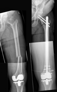 Oberschenkel - 2-Etagen-Bruch und Marknagelversorgung. Die Knieprothese liegt unabhängig davon ein und ist nicht betroffen.
