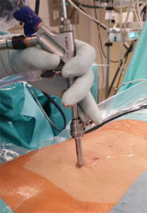 Endoskopische Bandscheibenchirurgie