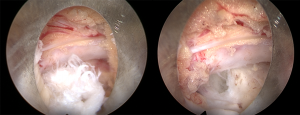 Endoskopische Bandscheibenoperation vor (links) und nach dem Vorfall (rechts)