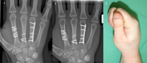 (1) 3-fache Mittelhandfraktur versorgt mit Schrauben und Platten (2) knöcherne Heilung 4 Monate später (3) aber noch eingeschränkte Fingerbeweglichkeit