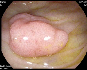 Endoskopisches Bild eines gestielten Polypen im Dickdarm