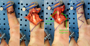 (1)+(2) Schnittverletzung des Zeigefingers mit Beugesehnen- und Nervendurchtrennung (3) Genähte Sehne, Mikrochirurgisch genähter Nerv (4) Situation nach Wundverschluss