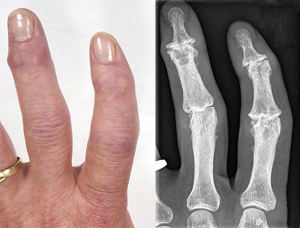 Schwere Herberden- und Bouchardarthrosen an Zeige- und Mittelfinger links als Foto und Röntgenbild bei derselben Patientin 