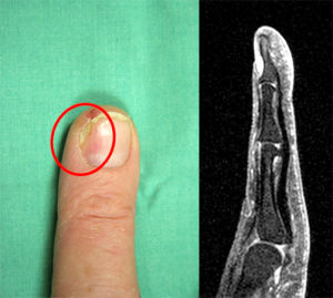 Glomustumor als Foto und im MRT vor OP; druckbedingt ist schon eine Nagelwachstumsstörung entstanden