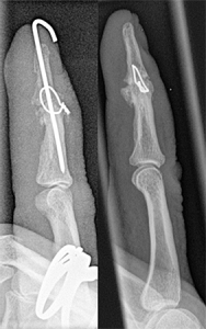 Versteifung des Endgelenkes am Zeigefinger der anderen Hand 1 und 5 Monate nach OP
