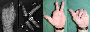 Vierfingeramputation, zwei Finger wurden replantiert und dienen als Gegengriffpartner zum Daumen