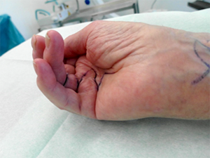 Eingeschränkte Fingerstreckung Mittel-, Ring- und Kleinfinger vor OP