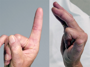 Funktion Zeigefinger rechts 5 Monate nach Versteifung des Endgelenkes