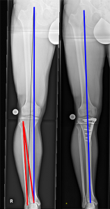 Umstellungsosteotomie eines O-Beines mit 9° Korrektur; Links vor OP: Tragachse läuft durch inneren Gelenkanteil, Rechts nach OP: Tragachse läuft genau durch die Mitte