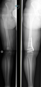 Umstellungsosteotomie eines X-Beines mit chronischer Kniescheibenausrecnkung, bewusste Überkorrektur in ein leichtes O-Bein. Links vor der OP, rechts nach der OP).