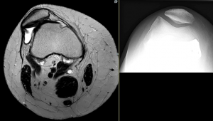 Ausgerenkte Kniescheibe im MRT vor der OP (links), zentrierte Kniescheibe nach OP (links)