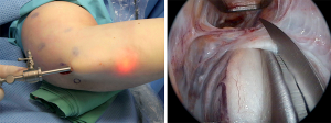 Kleiner Schnitt am Ellenbogen zur endoskopischen Operation (links), Endoskopische Sicht beim Durchtrennen von einengenden Strukturen über dem Ellennerv (rechts).
