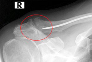 Schultergelenkarthrose: Erkennbar durch ausgeprägte Knochenanbauten/Osteophyten