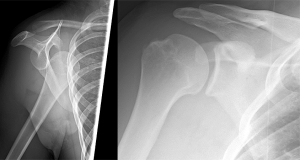 Schulterauskugelung: Der Arm ist nach vorne aus dem Gelenk gesprungen (links). Regelrechte Gelenkstellung zwischen Oberarmkopf und Gelenklpfanne (rechts).