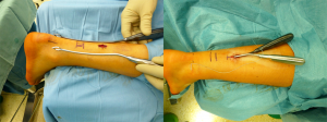 Minimalinvasive Achillessehnennaht: Kleiner Schnitt oberhalb der Ruptur (links), Naht mit speziellem Öseninstrumentarium, Rupturstelle wird nicht eröffnet (rechts).