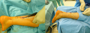 Minimalinvasive Naht: Durchziehen der Nähte zum Hautschnitt (links), Zug an den Nähten bewirkt Bewegung des Fußes nach unten (rechts).
