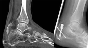 Knöcherner Achillessehnenausriss im CT (links), Refixation mit 3 Schrauben. DIe kleine Platte dient als Beilagscheibe (rechts).