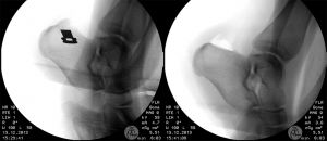 Haglundferse - Abtragung des störenden Fersenbeinanteils während der OP im Röntgenbild.