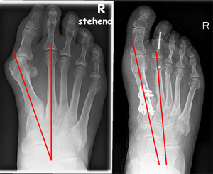 Hallux valgus - der WInkel zwischen erstem und zweitem Strahl beträgt 20° (links), Röntgenbild nach OP: Der Spreizfuß und der Hallux valgus sind nun durch eine Versteifung zwischen der Fußwurzel und dem ersten Mittelfußstrahl korrigiert (rechts)