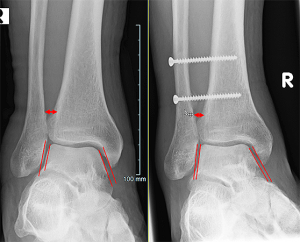 Bandverletzung am Sprunggelenk zwischen Schien- und Wadenbein mit dezenter Verbreiterung der Sprunggelenksgabel vor und nach Naht sowie Schraubenstabilisierung.