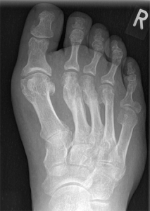 Röntgenbild vollständige Knochenheilung nach Mittelfußfraktur