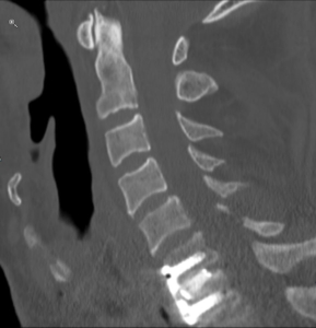 Das Foto stellt die Halswirbelsäule zwischen dem sechsten und siebten Halswirbel nach der Operation dar. 